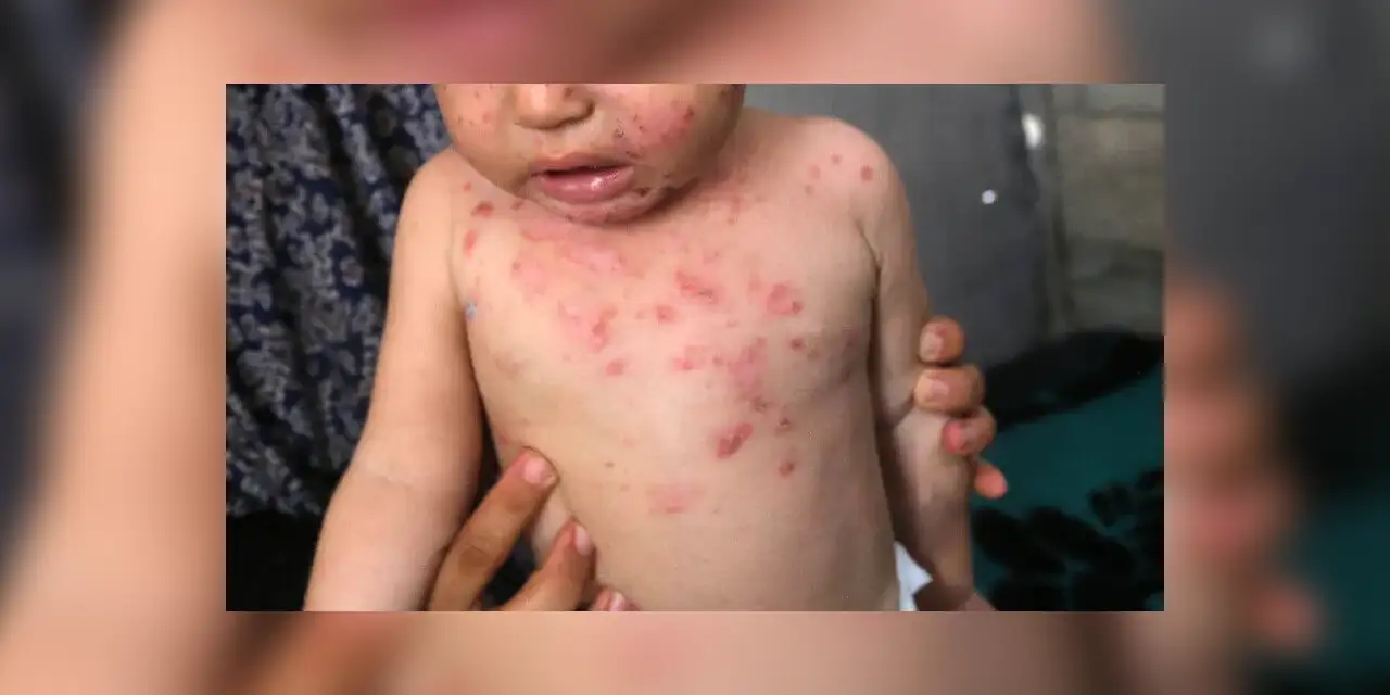 Gazze'de kötü yaşam koşulları çocuklar arasında suçiçeği salgınını büyütüyor